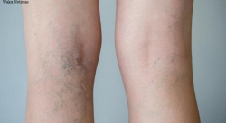 TIPOS DE VARICES Y LOS POSIBLES TRATAMIENTOS PARA ELIMINARLAS